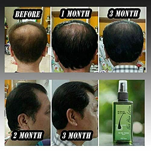 Yeni Saç Losyonu 4x120 ml Saç Dökülmesi Tedavisi Saç Aile Hafif Doğum Sonrası Saç Dökülmesi Platin Set Şampuan Serum Express